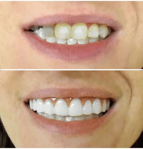 Dentadura Universal NewSmile Ajustável, Discreta e Confortável - Kit Prótese Dental Completa - Compre 1 e Leve 2